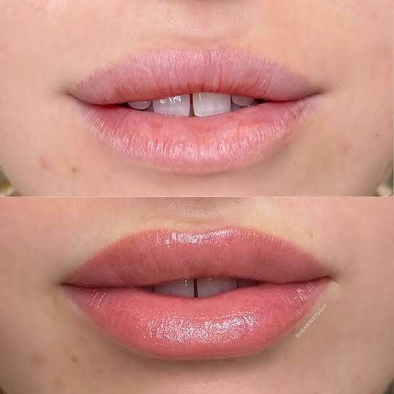 Dark Lip Correction Treatment is a method by which people can achieve brighter, lighter, and even-toned lips.