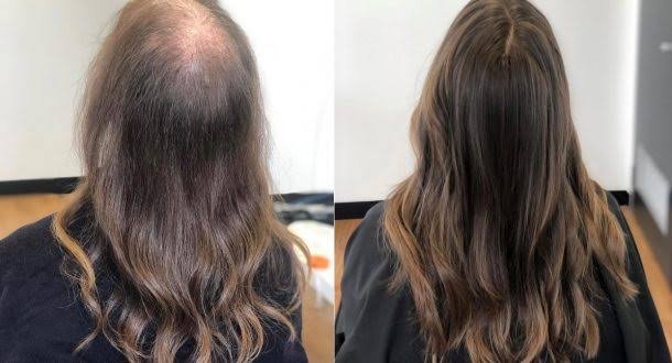 Hair thinning treatment