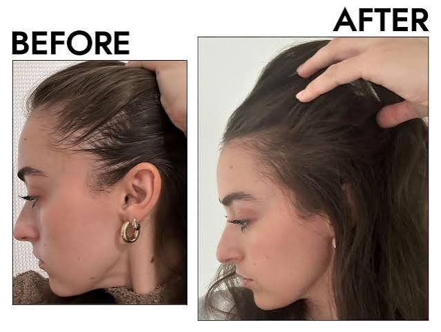 Hair Thinning Treatment