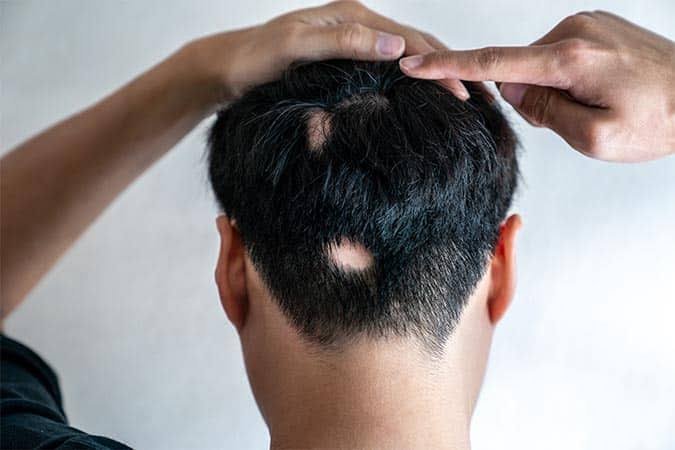 Alopecia Treatment